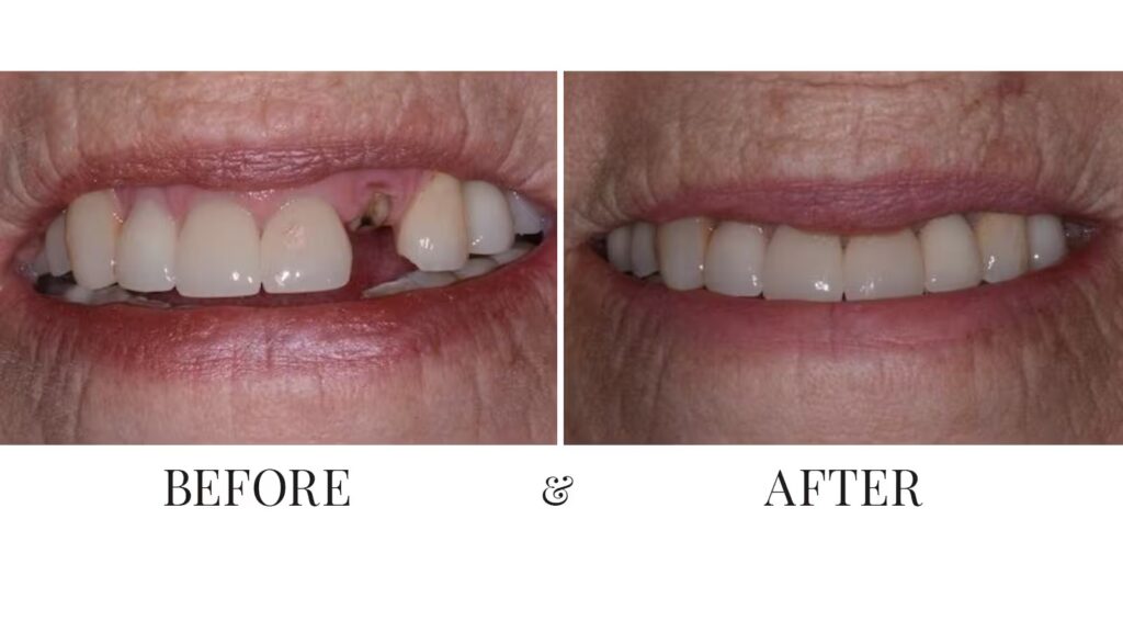 before after